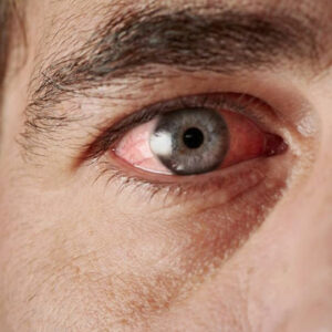 Effective Treatment Methods for Curing Red-eye